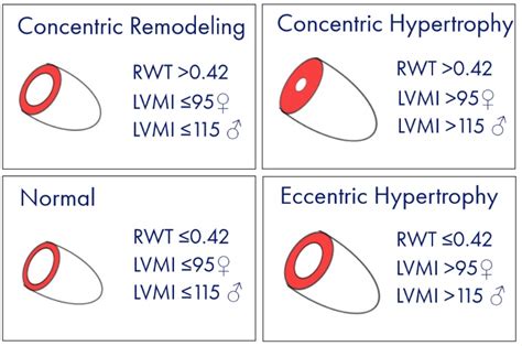 lvmi calculator|lv wall thickness calculator.